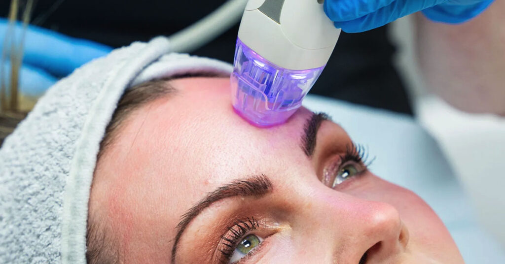 RF Microneedling Georgetown, TX